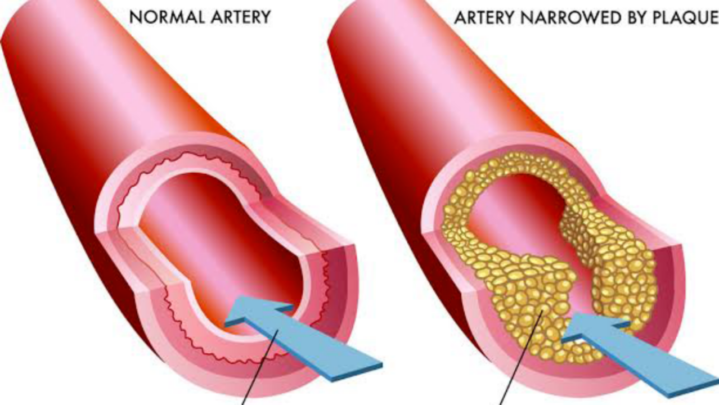 Plaque In Your Arteries? Know What Causes It