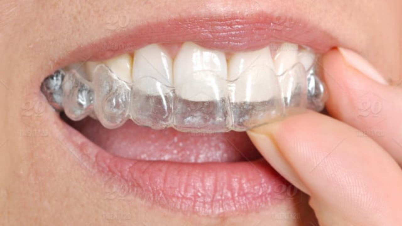 Pros & Cons Of Orthodontic Treatment With Clear Aligners SuccessYeti