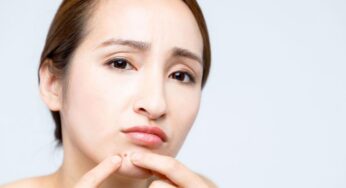 Reduce Redness From Pimples With These 5 Simple Home Remedies