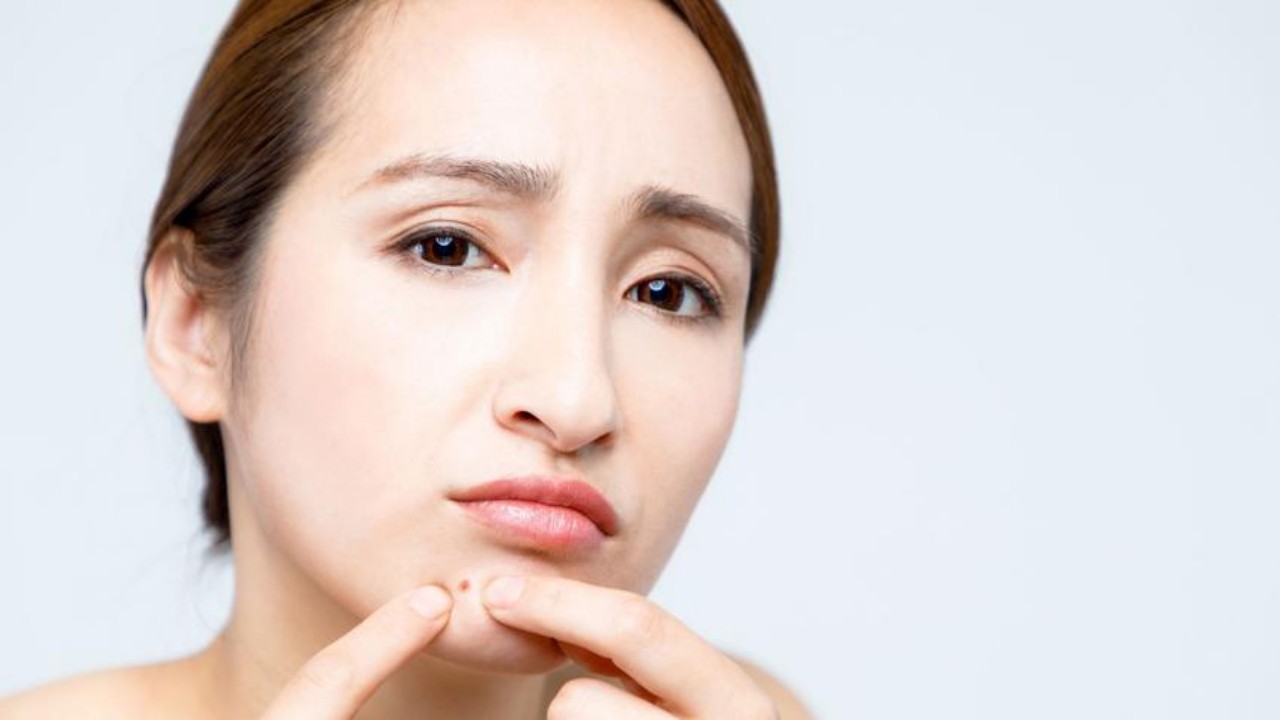 Reduce Redness From Pimples With These 5 Simple Home Remedies