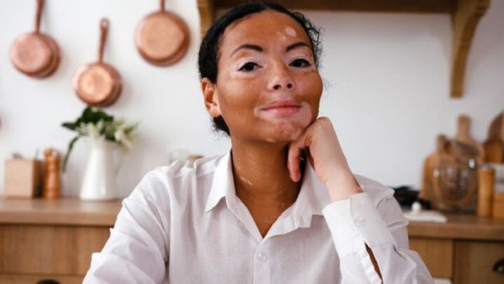 Vitiligo: Types, Symptoms & Causes