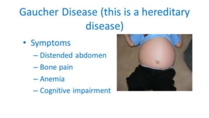 What Is Gaucher Disease? All You Need To Know