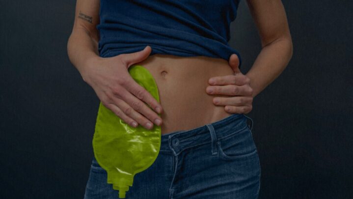 Crohn’s Disease: Symptoms, Diagnosis & Treatment