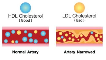 Good Cholesterol Vs Bad Cholesterol: Know The Difference