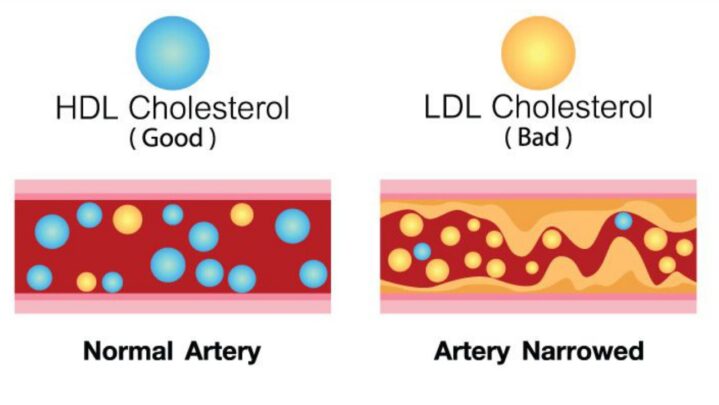 Good Cholesterol Vs Bad Cholesterol: Know The Difference
