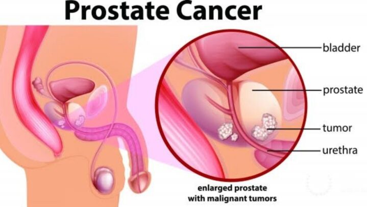 What Is Prostate Cancer? Know Its Symptoms And Causes