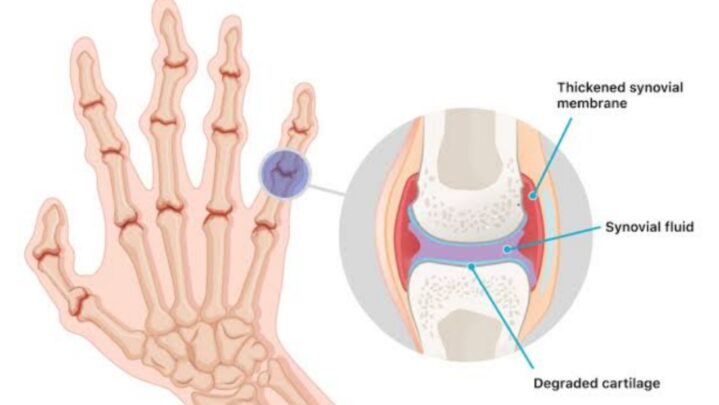 Medications For Rheumatoid Arthritis
