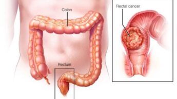 Tips To Prevent Rectal Cancer