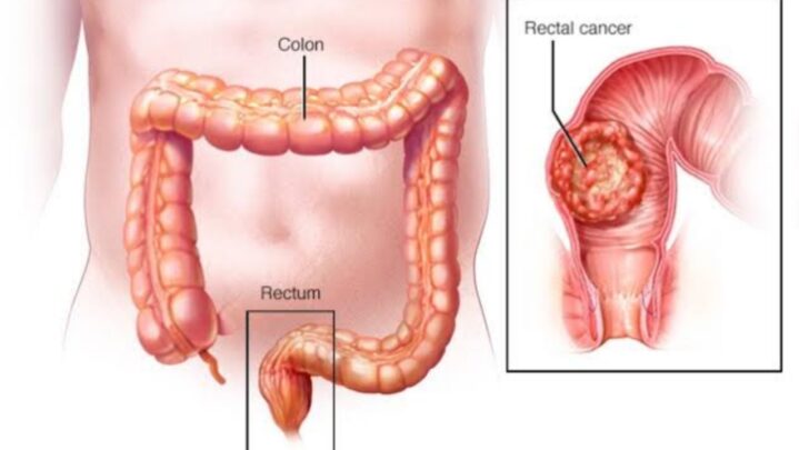 Test To Help You Find Rectal Cancer Spread