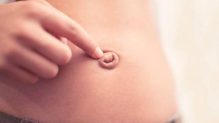 Umbilical Hernia: Causes And Symptoms