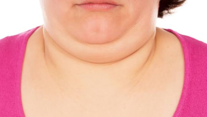 Best Exercises To Get Rid Of Double Chin