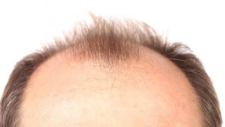 Why Does Baldness Affect Men? Read