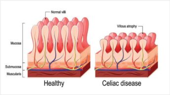 Celiac Disease: Causes & Complications