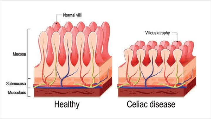 Celiac Disease: Causes & Complications