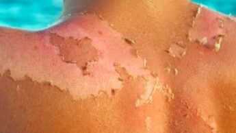 Dermatologist Approved Ways To Treat Sunburn: Read