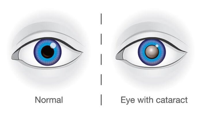 Risk Factor & Prevention Of Cataract: Read