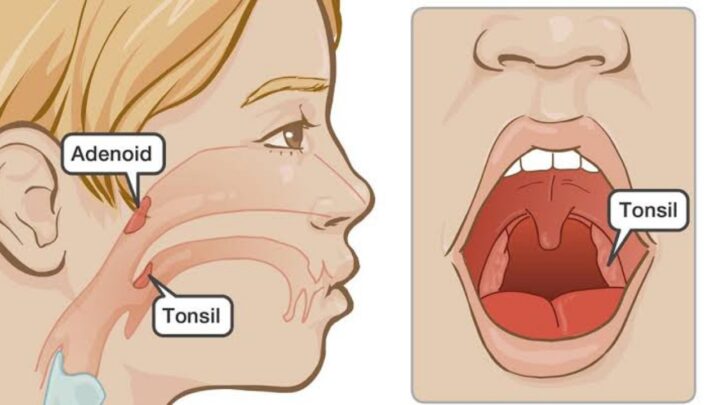 What Are Enlarged Adenoids? Causes & Its Diagnosis