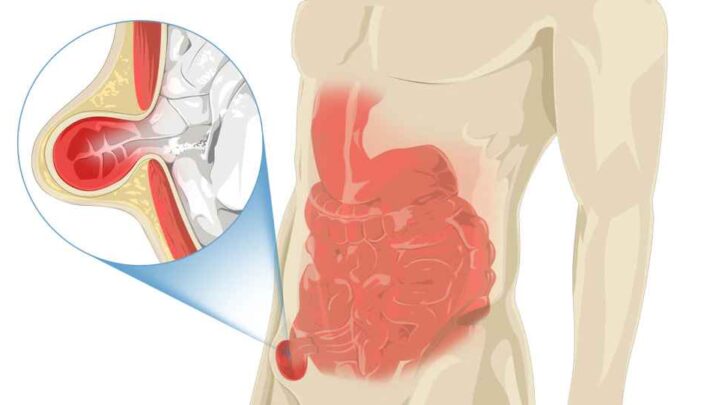 Hernia: Modifications In Lifestyle That Lower Chance Of Hernia