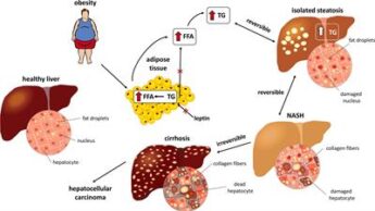 vitamin B Use May Decrease The Progression Of Advanced Non-Alcoholic Fatty Liver Disease, According To A Study