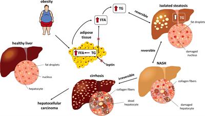 vitamin B Use May Decrease The Progression Of Advanced Non-Alcoholic Fatty Liver Disease, According To A Study