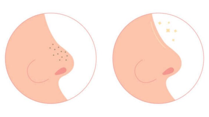 Get Rid Of Those Blackheads Right Now To Maintain Your Attractiveness