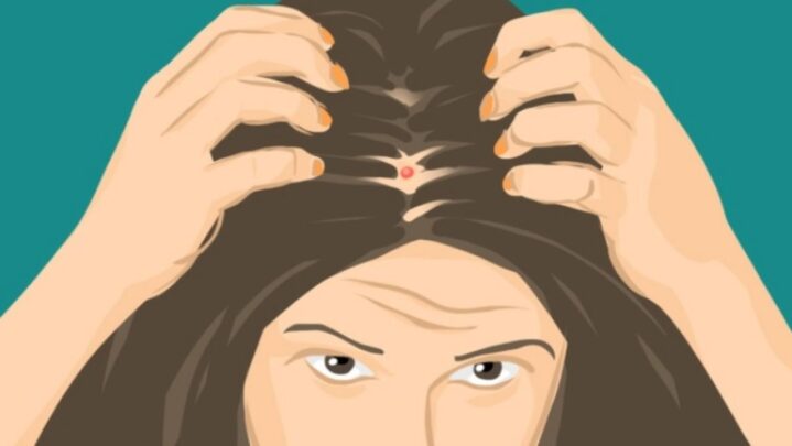 Acne On The Scalp? The Following Is How To Avoid It