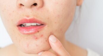 Don’t Burst That Pimple: First, Learn These Facts
