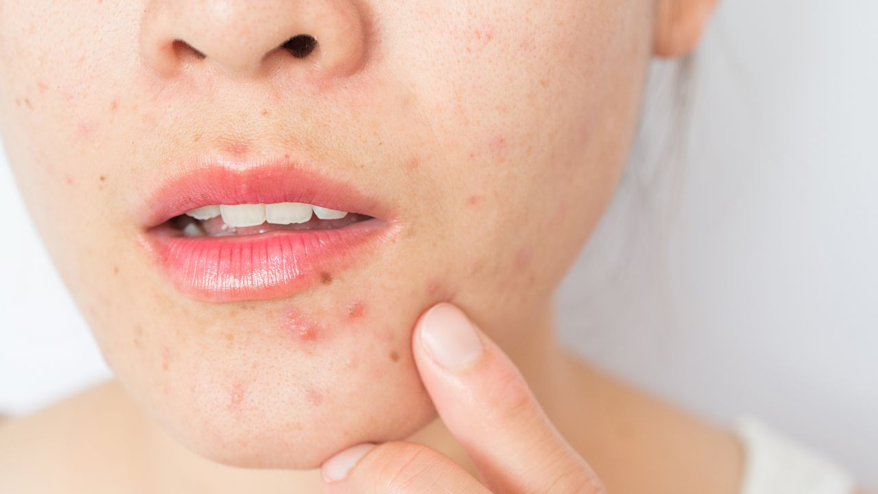 Don't Burst That Pimple: First, Learn These Facts