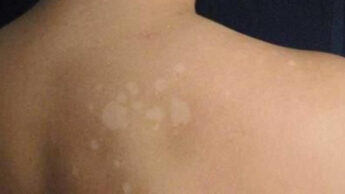 Causes, Symptoms, And Treatments For Sunspots