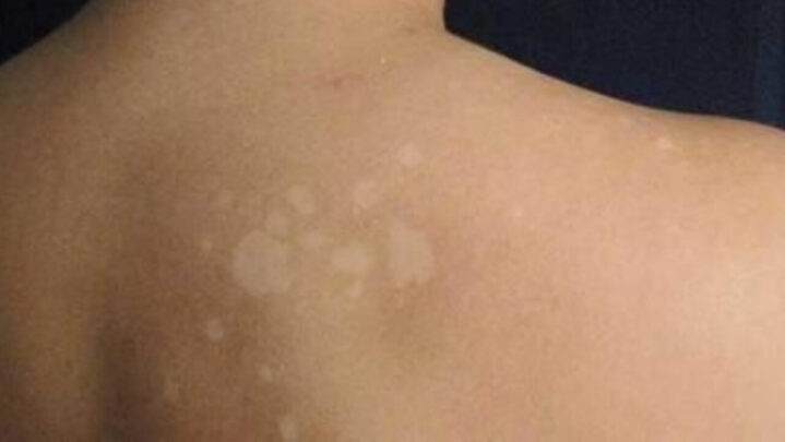 Causes, Symptoms, And Treatments For Sunspots