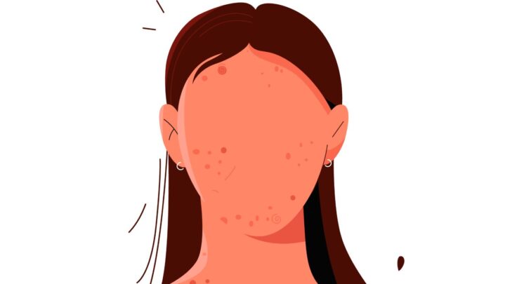 Myths About Acne Dispelled For Clear Skin